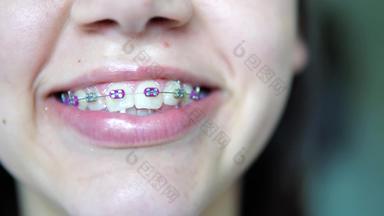 美女孩舌头矫正牙齿牙套配件口腔正畸学治疗